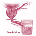 PCA 3 - Gene 3 do cancro da próstata
