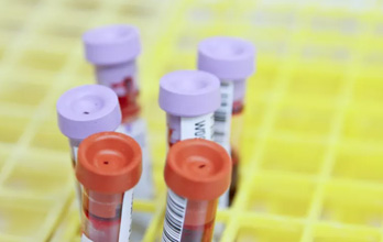 Sífilis: como é feito o diagnóstico? -  Sapo Lifestyle