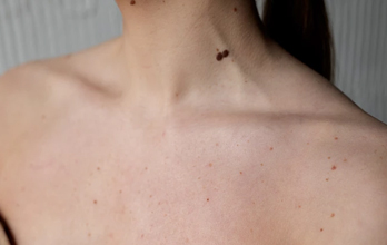 Melanoma: a importância das novas tecnologias no diagnóstico - Sapo Lifestyle