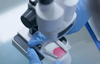 A génese e diagnóstico genético da arteriopatia cerebral autossómica dominante com enfartes subcorticais e leucoencefalopatia - Sapo Lifestyle