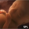 BBC Down's pregnancy blood test on trial - 2013