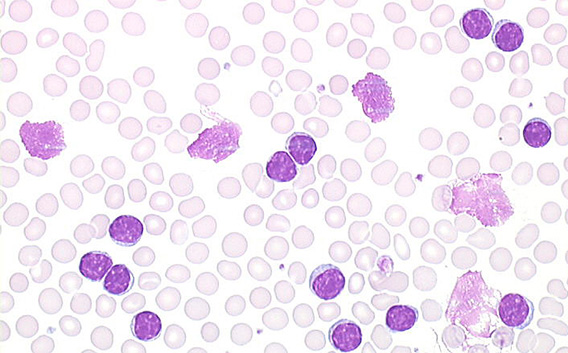 Leucemia linfocítica crónica B