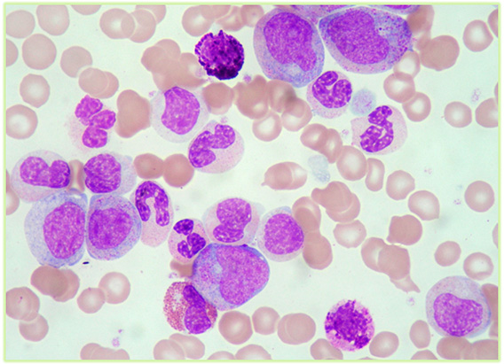 Leucemia mielóide crónica BCR-ABL1+