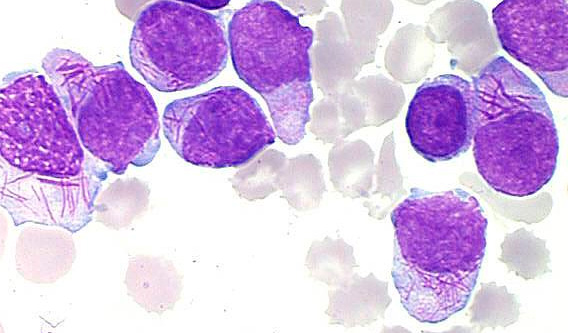 Leucemia promielocítica aguda